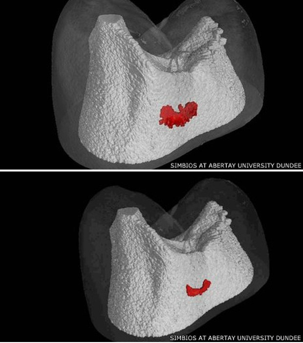 Imagem de cima mostra cárie dentária antes do tratamento e imagem de baixo mostra cárie depois do tratamento (Foto: Simbios at Abertay University Dundee/BBC)