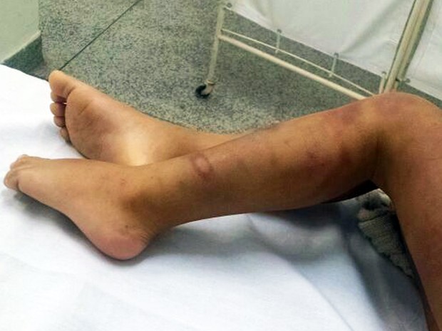 Menino de três anos tinha ferimento por todo o corpo em São Vicente, SP (Foto: Givanilse dos Santos/Arquivo Pessoal)