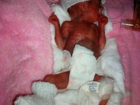 Bebe Que Nasceu Com 500 Gramas Recebe Alta Apos 5 Meses Em Sc Santa Catarina G1