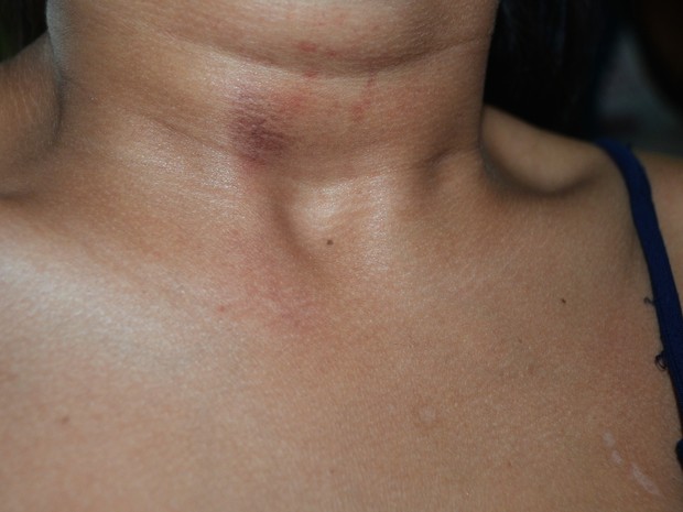 Jovem de 16 anos tem marcas do estrangulamento no pescoço  (Foto: Anny Barbosa/G1)