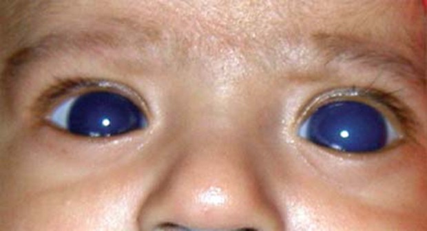 Olhos aumentados e azulados no glaucoma congênito Olhos aumentados e azulados no glaucoma congênito
