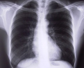 Embolia Pulmonar Entenda A Doenca Que Causa 15 De Mortes Subitas O Programa Programas