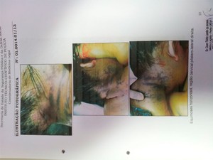 Marcas de asfixia no pescoço de Fabiana Caggiano (Foto: Reprodução/Henrique Dovalle/Inter TV Cabugi)