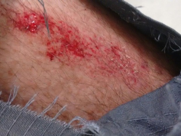 Policial ficou levemente ferido após ser mordido por suspeito durante prisão em Praia Grande, SP (Foto: G1)