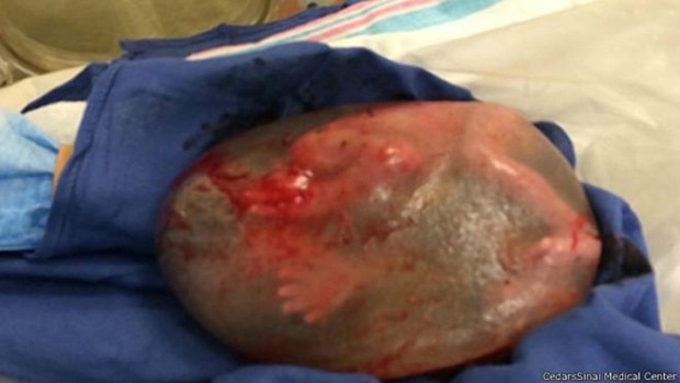 Parto sem rompimento da bolsa amniótica ocorre uma vez a cada 80 mil partos (Foto: Cedars-Sinai Medical Center/BBC)