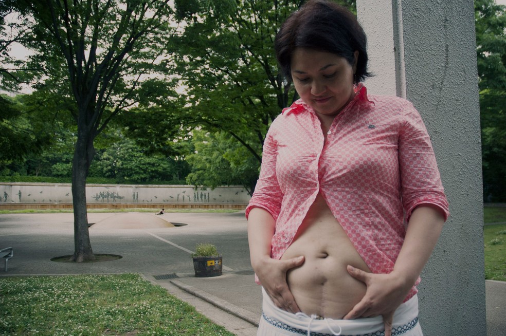 Samanta Yoshida diz não ter vergonha da cicatriz deixada pelo procedimento cirúrgico  (Foto: Ewerthon Tobace/BBC Brasil)