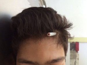 Jovem de 13 anos foi parar no hospital com lápis na cabeça (Foto: Arquivo Pessoal)