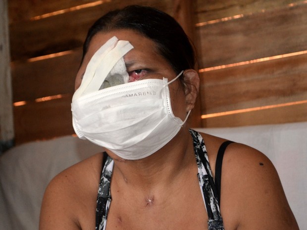 Mulher perdeu parte do rosto por causa da demora em cirurgia (Foto: Abinoan Santiago/G1)