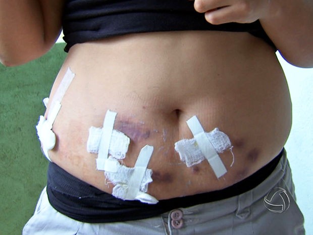 Paciente contou que tratamento gerou diversas feridas na barriga (Foto: Reprodução/TVCA)