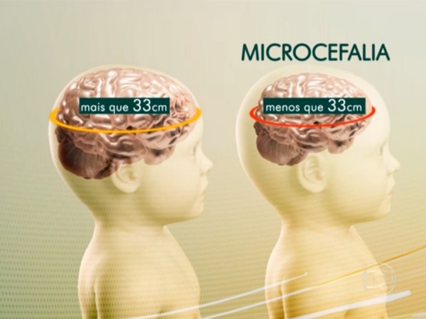 microcefalia jornal hoje (Foto: Tv Globo)