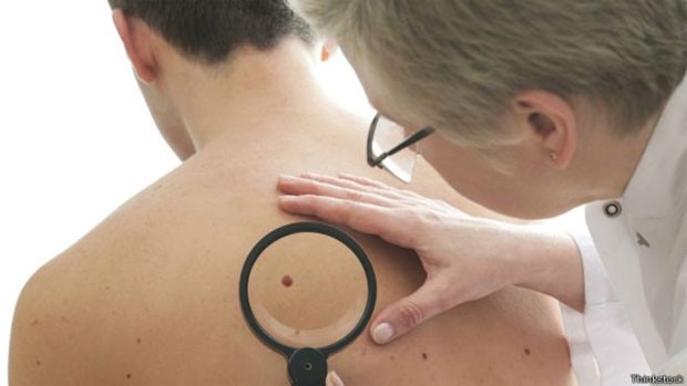 Pesquisa foi feita com 945 pacientes com melanoma avançado (Foto: Thinkstock)