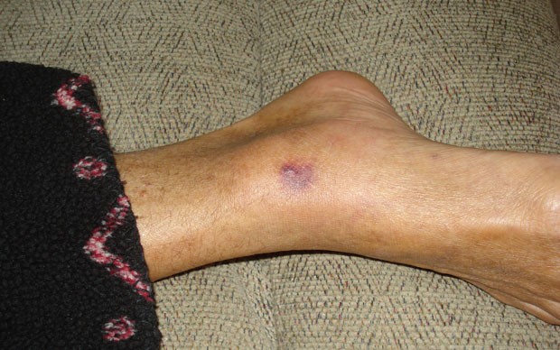 Lesão no pé de Henry (Foto: Patty Konietzky/AP)