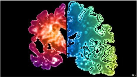 Imagem mostra diferença na densidade do tecido cerebral com e sem demência (à dir.) (Foto: SPL/BBC)