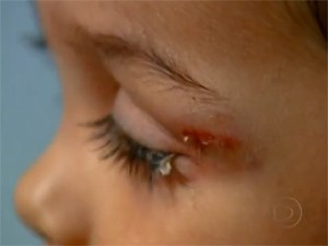 Bebê teve olho colado em hospital (Foto: Reprodução/TV Globo)