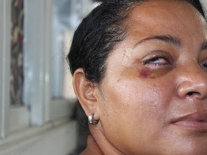 Duas semanas após a agressão o olho de Adriana ainda apresenta hematomas (Foto: Patrícia Andrade/G1)