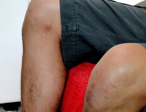 joelho Alex SIlva após cirurgia (Foto: Lucas Catta Prêta / Globoesporte.com)