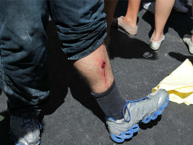 Manifestante registrou ferimento feito com tiro de bala de borracha (Foto: Eleylson Campelo/VC no G1)