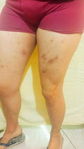Infecção nas pernas de Ken Humano (Foto: Divulgação)