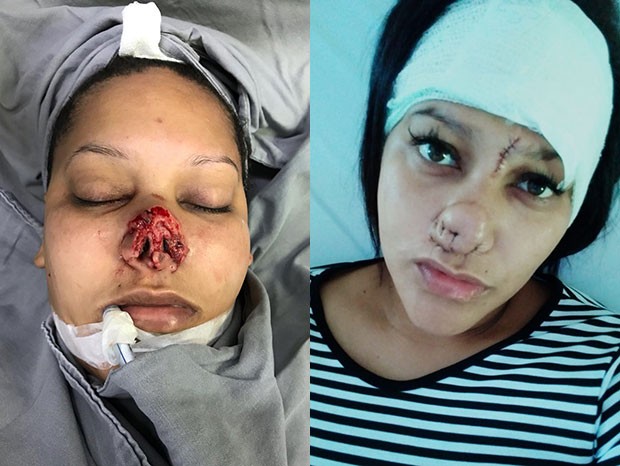 Talita Oliveira logo após a violência e após cinco cirurgias plásticas (Foto: Arquivo pessoal) Talita Oliveira logo após a violência e após cinco cirurgias plásticas (Foto: Arquivo pessoal)