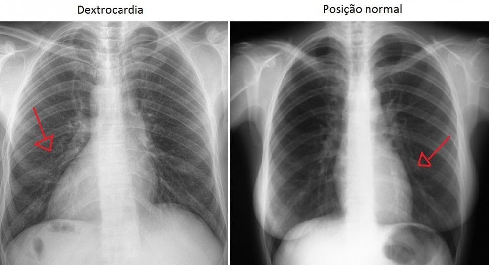 Radiografia mostra o posicionamento do coração  (Foto: A Gazeta)