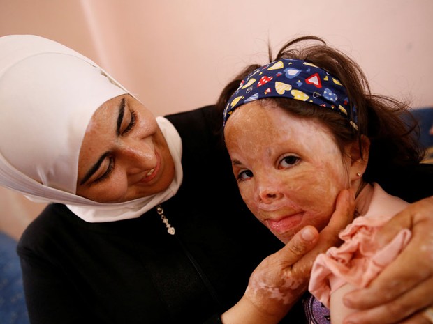 Limar, de seis anos, com a sua mãe; ela foi atingida pela explosão de um míssil na Síria (Foto: Tumay Berkin/Reuters) Limar, de seis anos, com a sua mãe; ela foi atingida pela explosão de um míssil na Síria (Foto: Tumay Berkin/Reuters)