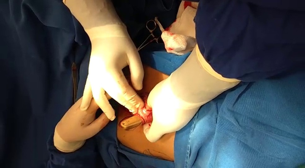 Cirurgia para a retirada do aparelho aconteceu em Itapetininga (Foto: Divulgação/SAP)