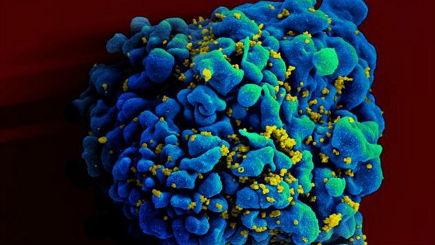 Células-T foram alteradas geneticamente com mutação que dá resistência à ação do HIV (Foto: BBC)