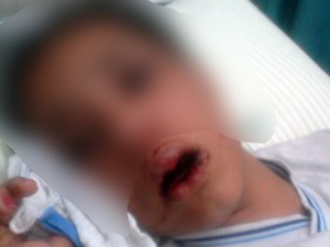 Menina de 13 anos perdeu dois dentes e ficou com vários hematomas (Foto: Arquivo pessoal)