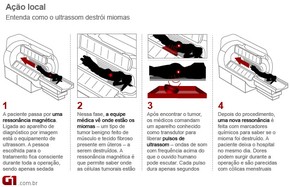 Infográfico MRgFUS 1 (Foto: Arte / G1) Infográfico MRgFUS 1 (Foto: Arte / G1)