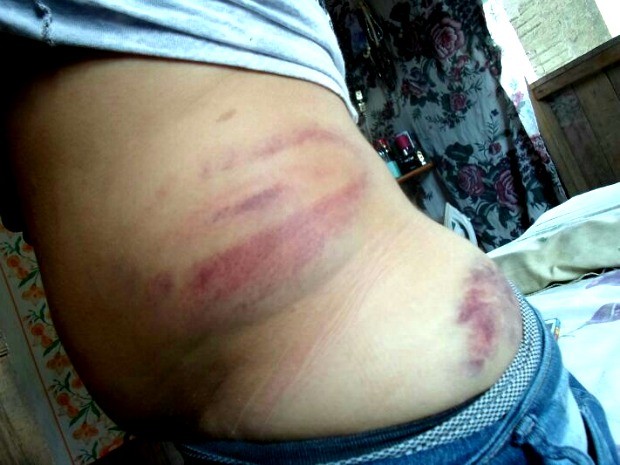 Jovem diz ter sido agredida com cassetete  (Foto: Francinéia Melo/ Arquivo pessoal)