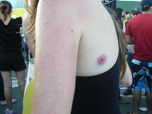 Professora mostra marcas de bala de borracha no corpo (Foto: Gioras Xerez/G1)