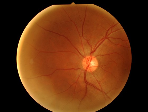 Projeto busca identificar sinais que podem levar a doenças sérias de visão (Foto: ThinkStock/Getty Images)