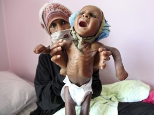 Mulher mostra sua filha desnutrida em uma clínica terapêutica no hospital Al-Sabyeen, em Sanaa, no Iêmen. Segundo a Unicef, 57% das cerca de 12 milhões de crianças do país estão com níveis crônicos de desnutrição, nível só menor que o do Afeganistão. (Foto: Mohammed al-Sayaghi/Reuters)