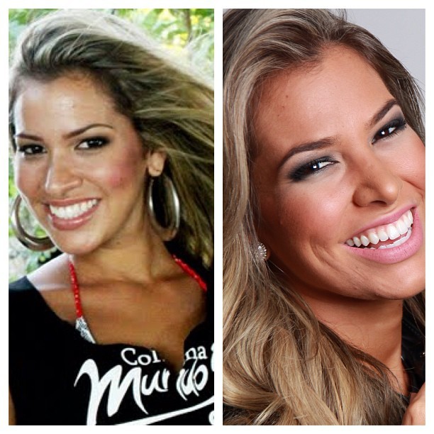 O antes e o depois do nariz da ex-BBB Adriana (Foto: Instagram/ Reprodução)
