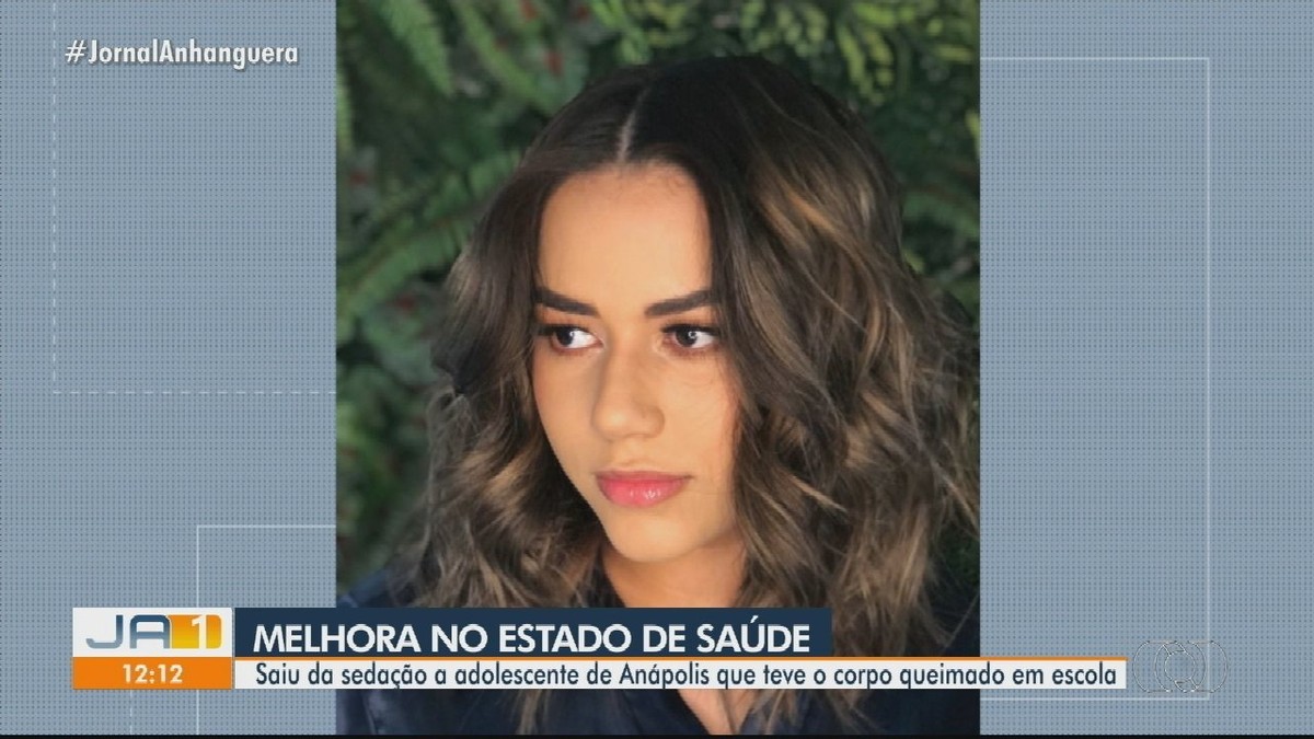 Estudante Que Teve Corpo Queimado Durante Experimento Na Escola Sai Da