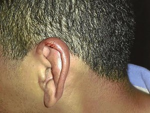 Imagem mostra ferimento na orelha do professor (Foto: Paulo José da Silva/Arquivo Pessoal)