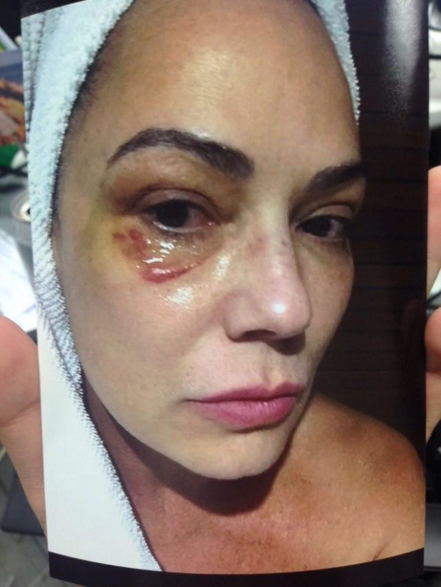 Luiza Brunet em foto feita após agressão que ela afirma ter sofrido do ex-marido, Lírio Parisotto (Foto: Reprodução Fantástico)