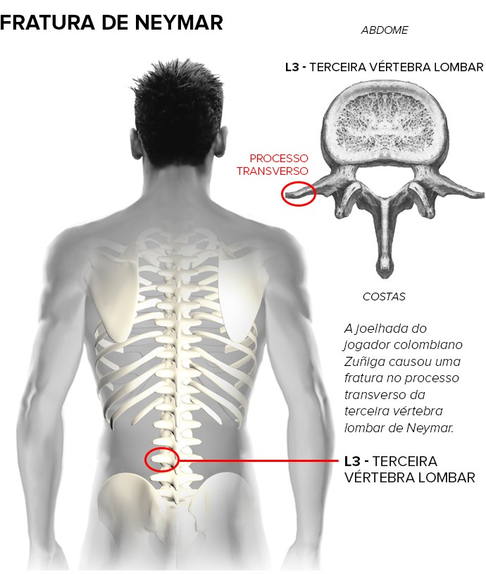 fratura neymar 2 (Foto: arte esporte)