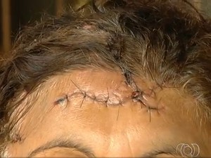 Mulher teve ferimentos na cabeça devido ao ataque, em Goiânia, Goiás (Foto: Reprodução/ TV Anhanguera)