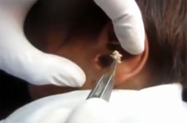 Médico retirou vermes do ouvido de jovem indiano  (Foto: Reprodução/YouTube/ OPRACLEAKsALCAER)