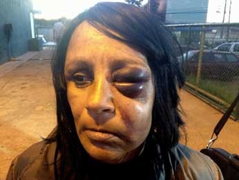 A dona de casa Márcia Rosa da Costa, de 45 anos, com o rosto marcado por agressões que diz ter sofrido de policiais em Sobradinho, no DF (Foto: Isaura Morgana/G1)