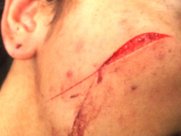 A agressão foi com uma lâmina de barbeador. (Foto: Silvana Rust/ Terceira Via)
