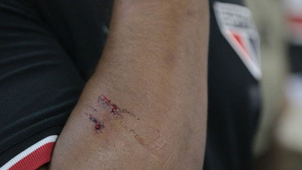 Braço de um dos seguranças do São Paulo após o confronto no vestiário (Foto: Rubens Chiri / site oficial do SPFC)