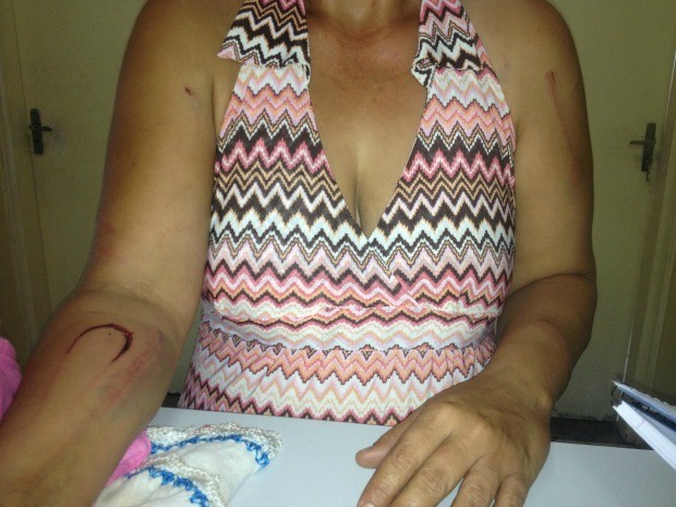 Mulher mostra os hematomas que foram o resultado da violncia (Foto: Nadyenka Castro / G1 MS)