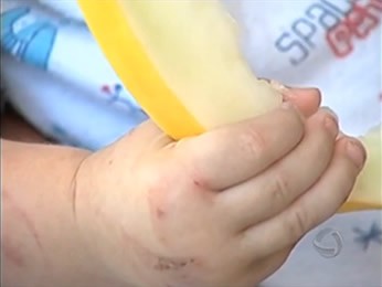 Bebê levou mais de 30 mordidas em creche de Sinop. (Foto: Reprodução/TVCA)