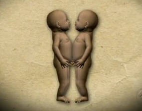 As crianças estavam unidas pela região toraco-abdominal frontal, e compartilhavam o mesmo fígado e o coração, que apresentava má formação. (Foto: Reprodução/TV Liberal) As crianças estavam unidas pela região toraco-abdominal frontal, e compartilhavam o mesmo fígado e o coração, que apresentava má formação. (Foto: Reprodução/TV Liberal)