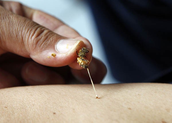 Joel Magsaysay usa picada de abelha para tratar pacientes com doenças como a paralisia, hipotireoidismo e câncer. Magsaysay disse o veneno da abelha contém um potente cocktail de proteínas que aumentam a auto-imune do sistema que permitem que o corpo ativ (Foto: Erik De Castro/Reuters)