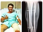 Ex-BBB Fael, que quebrou a perna em três lugares, terá alta no domingo