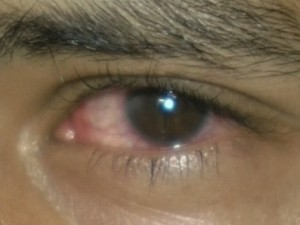 Olho do estudante ainda está avermelhado e, segundo dele, arde, em Ipameri, Goiás (Foto: Reprodução/ TV Anhanguera)