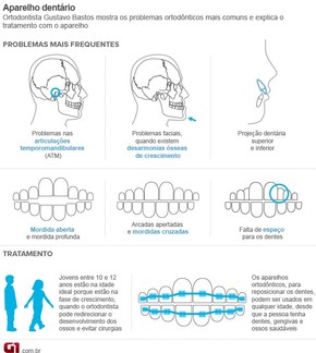 Entenda As Causas E Tratamentos De Desgastes E Espaco Entre Os Dentes Bem Estar G1